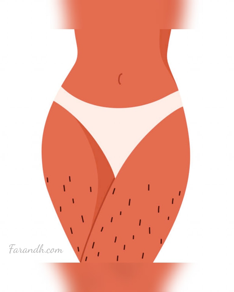 طرق طبيعية لإزالة الشعر للفتيات